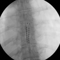 spinal stenosis treatment device x ray