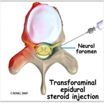Epidural steroid injections for disc prolapse