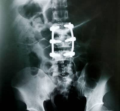Post spine surgery back pain treatment case report