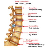 Stages of disc degeneration — normal, degenerative, bulging, herniated and thinning disc with osteophyte formation