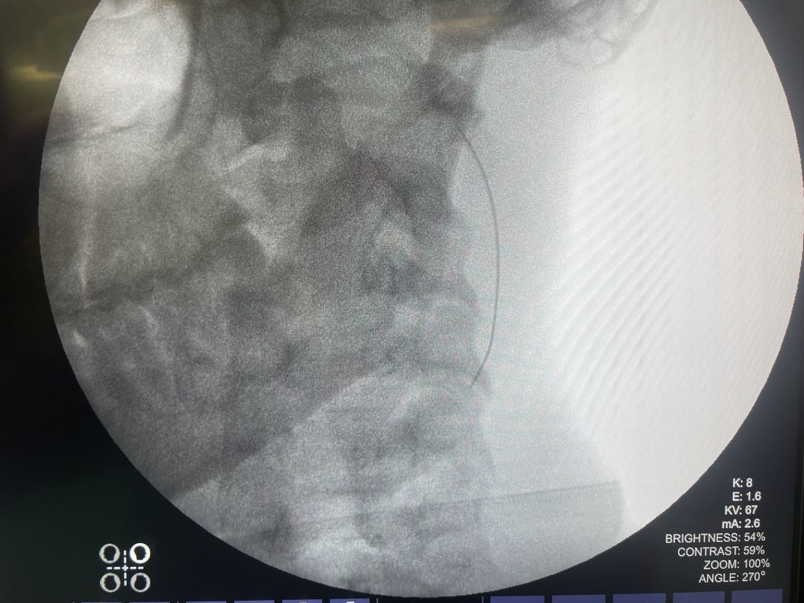 Live fluoroscopy image used to guide needle placement during a spine procedure