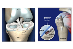 knee prolotherapy