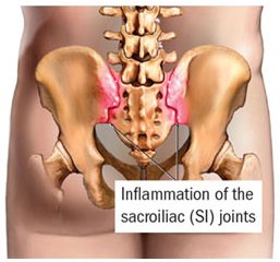 Inflammed Sacroiliac Joint
