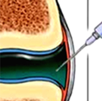 Intra-articular injections