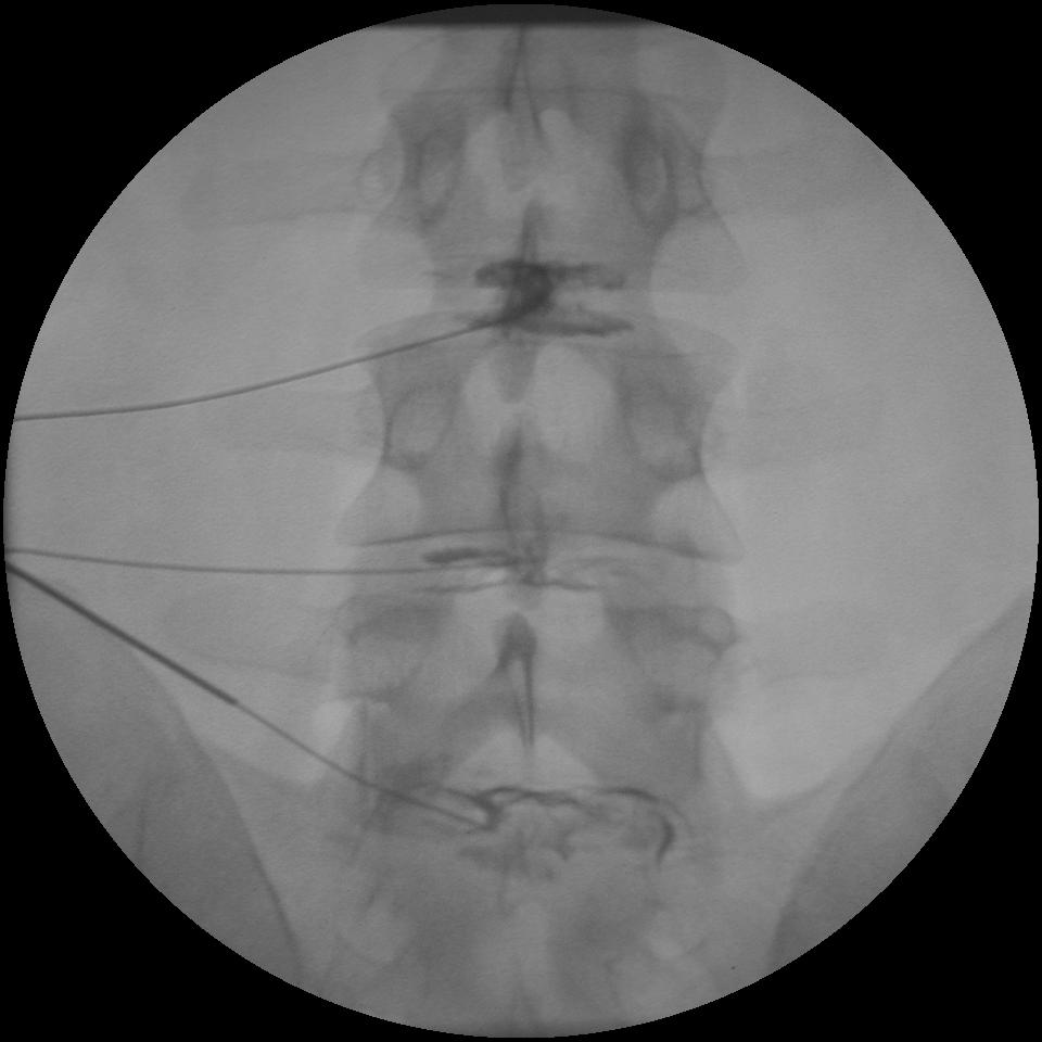 Cervical discography