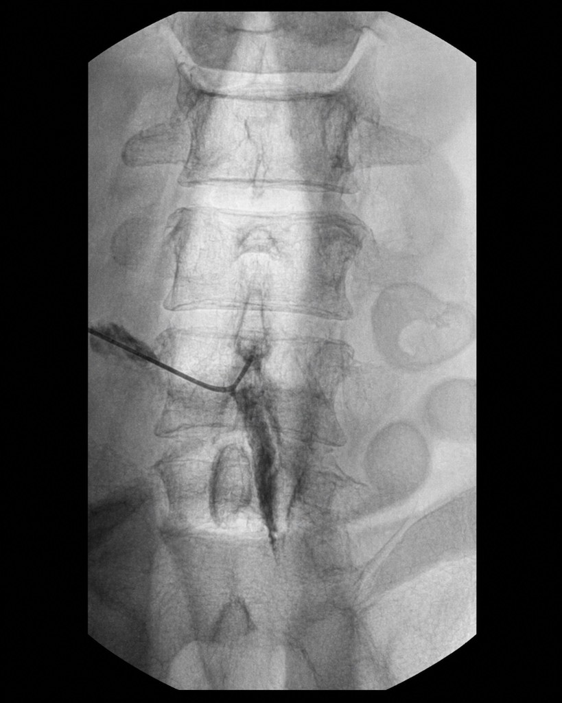 Cervical epidural injection fluoroscopy image