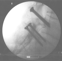 Caudal Epiduroplasty