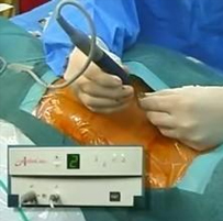 Dekompressor Discectomy