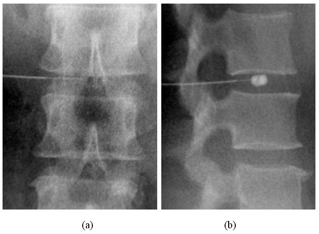 Ozone discectomy disc injection