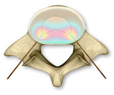 percutaneous biaculoplasty reference image