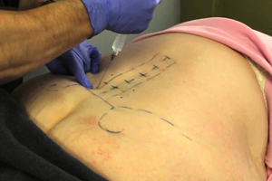 prolotherapy reference image