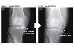 prolotherapy reference image