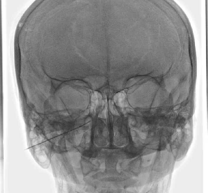 Sphenopalatine Ganglion Block treatment
