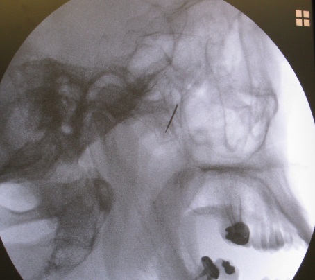 Sphenopalatine Ganglion Block treatment mumbai