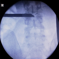 transforaminal endoscopic discectomy reference image