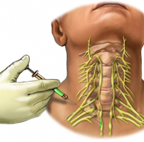 Peripheral nerve block
